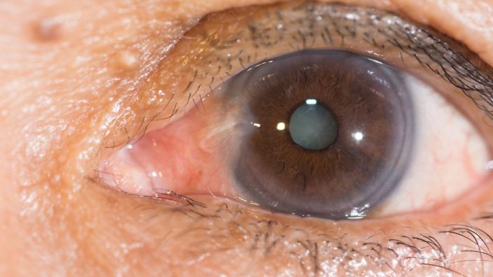 Close,Up,Of,The,Pterygium,And,Senile,Cataract,During,Eye